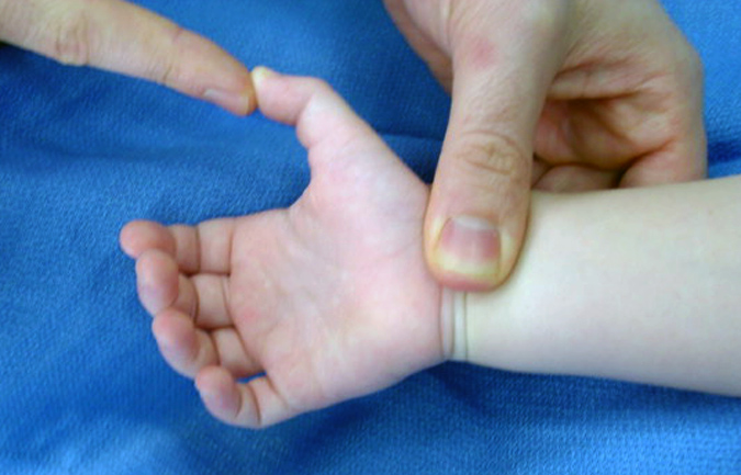 trigger-thumb-pediatric-hand-surgery-source